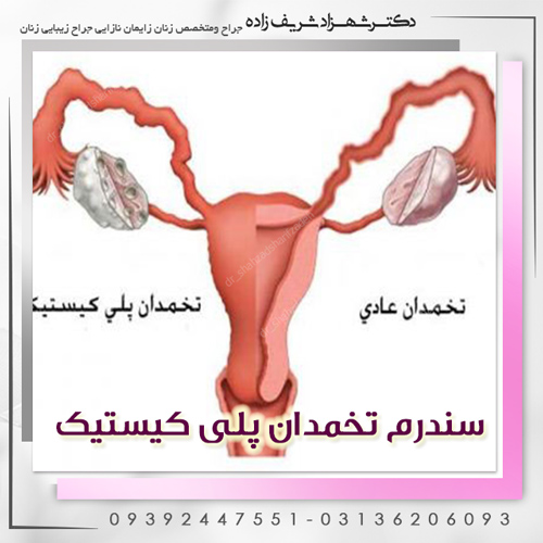 سندرم-تخمدان-پلی-کیستیک