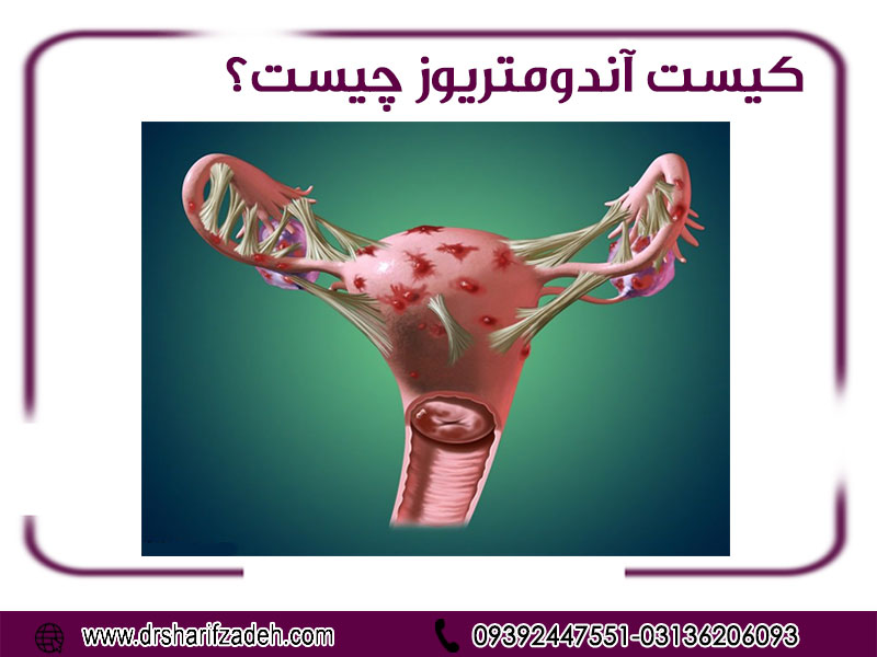 كيست-آندومتريوز-چيست؟