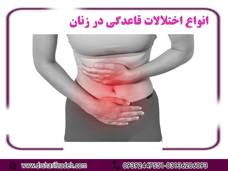 انواع اختلالات قاعدگی در زنان