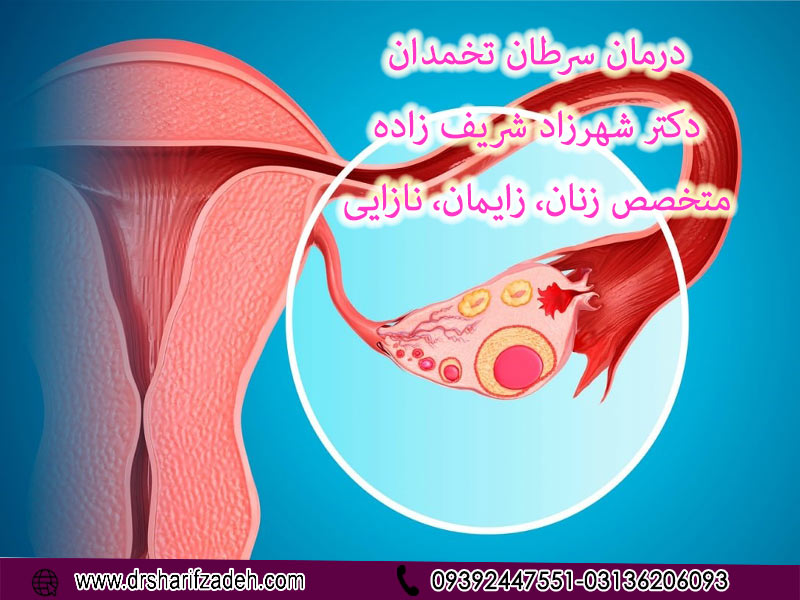 درمان-سرطان-تخمدان