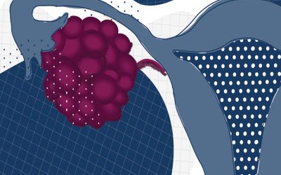 آیا سرطان تخمدان قابل درمان است؟