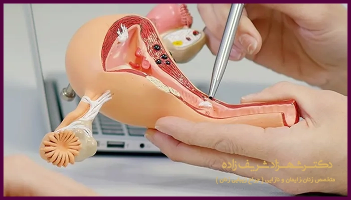 بهترین روش درمان فیبروم رحم