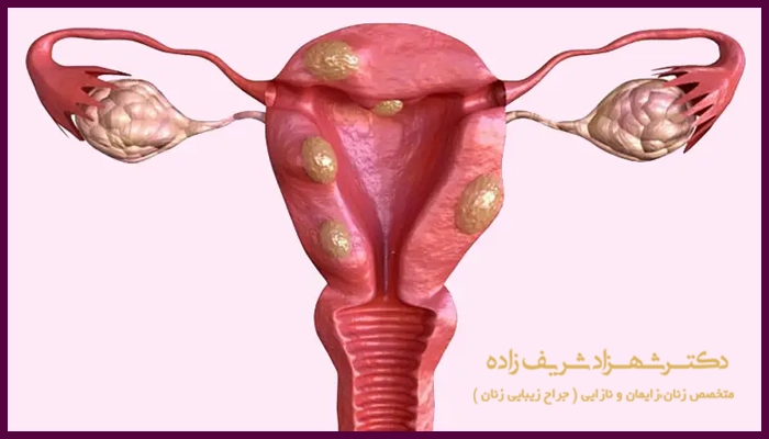 علائم فیبروم رحمی