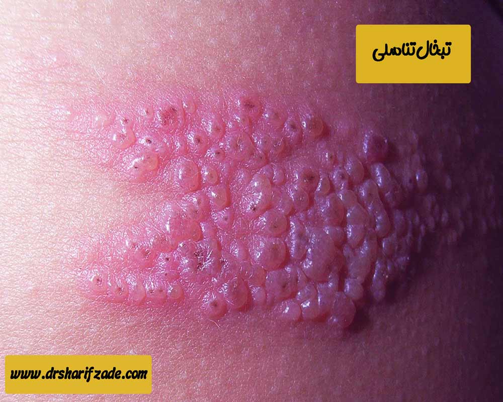 تبخال-تناسلی