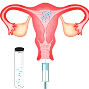 مزایا و معایب IUI