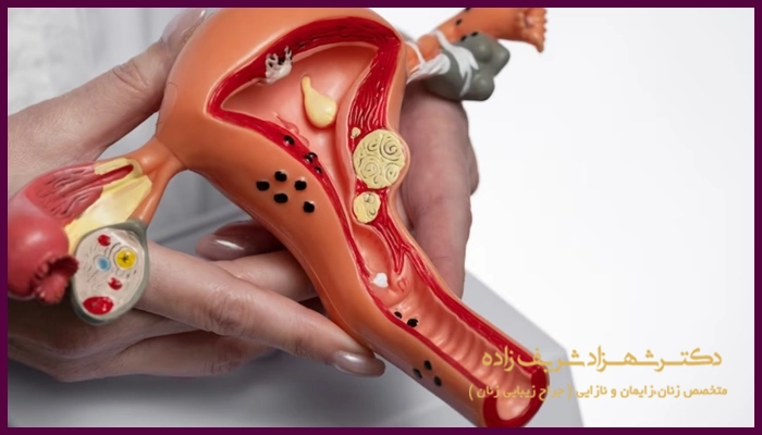 جراحی میومکتومی برای چه کسانی مناسب است؟