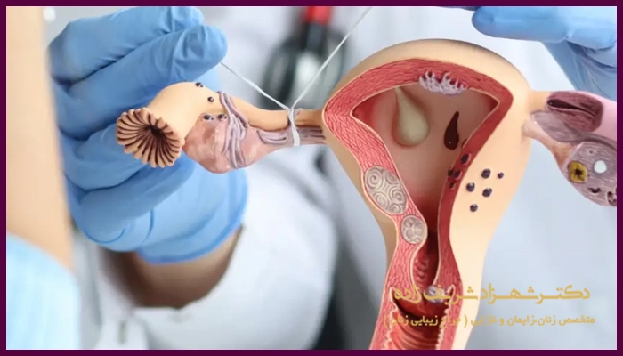 بستن لوله زنان در چه سنی انجام می شود